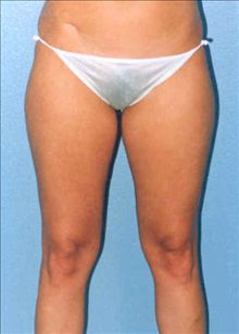 Liposuction Before Photo by Daniel Mills, MD; ,  - Case 24593