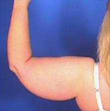 Liposuction Before Photo by Daniel Mills, MD; ,  - Case 24599