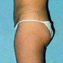 Liposuction After Photo by Daniel Mills, MD; ,  - Case 24600