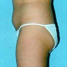 Liposuction Before Photo by Daniel Mills, MD; ,  - Case 24600