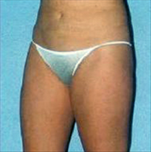 Liposuction After Photo by Daniel Mills, MD; ,  - Case 24600
