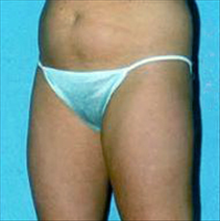 Liposuction Before Photo by Daniel Mills, MD; ,  - Case 24600