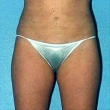 Liposuction After Photo by Daniel Mills, MD; ,  - Case 24600