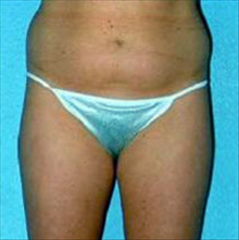 Liposuction Before Photo by Daniel Mills, MD; ,  - Case 24600