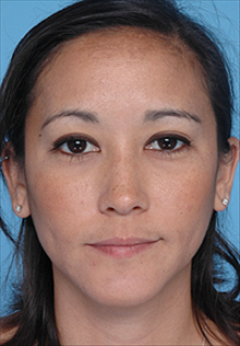 Liposuction Before Photo by Daniel Mills, MD; Laguna Beach, CA - Case 24605