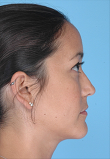 Liposuction After Photo by Daniel Mills, MD; Laguna Beach, CA - Case 24605