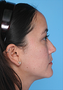 Liposuction Before Photo by Daniel Mills, MD; Laguna Beach, CA - Case 24605