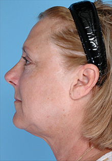 Liposuction After Photo by Daniel Mills, MD; ,  - Case 24606