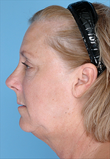 Liposuction Before Photo by Daniel Mills, MD; ,  - Case 24606