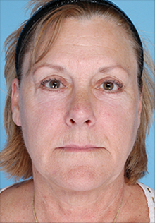 Liposuction After Photo by Daniel Mills, MD; ,  - Case 24606