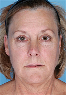 Liposuction Before Photo by Daniel Mills, MD; ,  - Case 24606