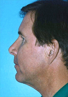 Liposuction After Photo by Daniel Mills, MD; ,  - Case 24609