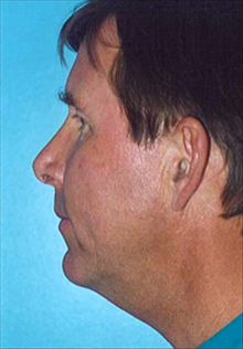 Liposuction Before Photo by Daniel Mills, MD; ,  - Case 24609