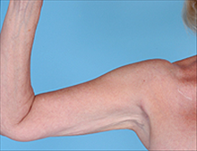 Liposuction After Photo by Daniel Mills, MD; ,  - Case 24612