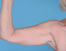 Liposuction Before Photo by Daniel Mills, MD; ,  - Case 24612