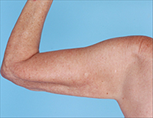 Liposuction After Photo by Daniel Mills, MD; ,  - Case 24612