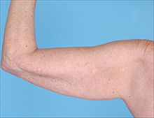 Liposuction Before Photo by Daniel Mills, MD; ,  - Case 24612