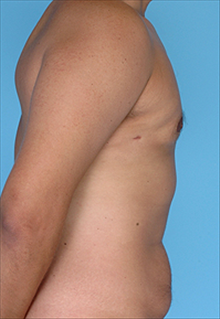 Liposuction After Photo by Daniel Mills, MD; Laguna Beach, CA - Case 24614