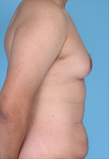 Liposuction Before Photo by Daniel Mills, MD; Laguna Beach, CA - Case 24614
