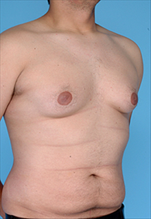 Liposuction Before Photo by Daniel Mills, MD; Laguna Beach, CA - Case 24614