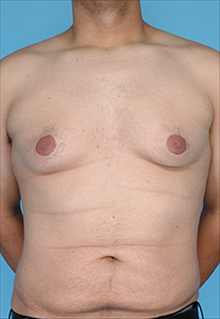 Liposuction Before Photo by Daniel Mills, MD; Laguna Beach, CA - Case 24614