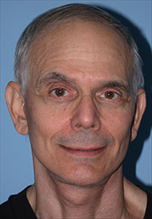 Facelift After Photo by Daniel Mills, MD; Laguna Beach, CA - Case 24619