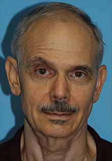 Facelift Before Photo by Daniel Mills, MD; Laguna Beach, CA - Case 24619