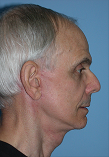Facelift After Photo by Daniel Mills, MD; Laguna Beach, CA - Case 24619