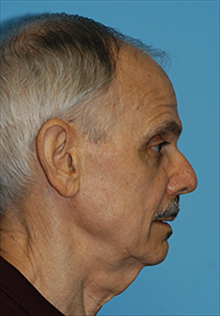 Facelift Before Photo by Daniel Mills, MD; Laguna Beach, CA - Case 24619