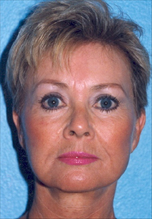 Facelift After Photo by Daniel Mills, MD; Laguna Beach, CA - Case 24623