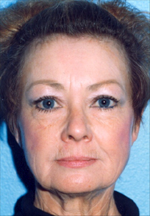 Facelift Before Photo by Daniel Mills, MD; Laguna Beach, CA - Case 24623