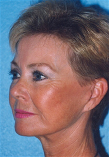 Facelift After Photo by Daniel Mills, MD; Laguna Beach, CA - Case 24623