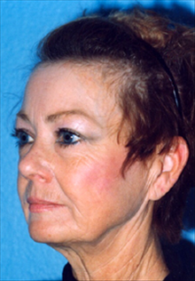 Facelift Before Photo by Daniel Mills, MD; Laguna Beach, CA - Case 24623