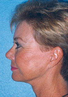 Facelift After Photo by Daniel Mills, MD; Laguna Beach, CA - Case 24623