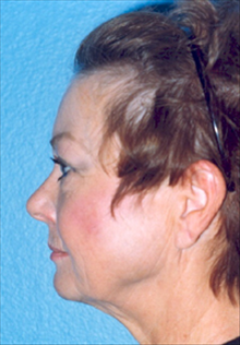 Facelift Before Photo by Daniel Mills, MD; Laguna Beach, CA - Case 24623