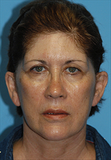 Facelift After Photo by Daniel Mills, MD; Laguna Beach, CA - Case 24624