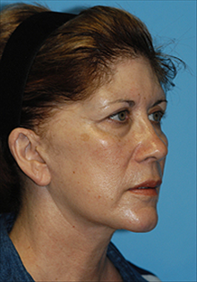 Facelift After Photo by Daniel Mills, MD; Laguna Beach, CA - Case 24624