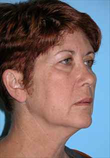 Facelift Before Photo by Daniel Mills, MD; Laguna Beach, CA - Case 24624