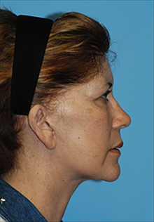 Facelift After Photo by Daniel Mills, MD; Laguna Beach, CA - Case 24624