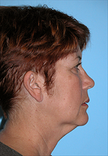 Facelift Before Photo by Daniel Mills, MD; Laguna Beach, CA - Case 24624