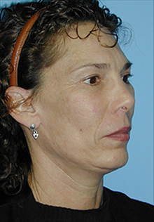 Facelift After Photo by Daniel Mills, MD; Laguna Beach, CA - Case 24630