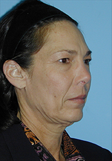 Facelift Before Photo by Daniel Mills, MD; Laguna Beach, CA - Case 24630
