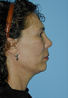 Facelift After Photo by Daniel Mills, MD; Laguna Beach, CA - Case 24630