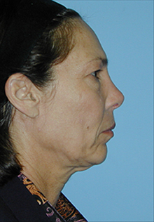 Facelift Before Photo by Daniel Mills, MD; Laguna Beach, CA - Case 24630