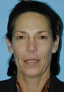 Facelift Before Photo by Daniel Mills, MD; Laguna Beach, CA - Case 24630