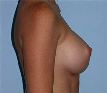 Breast Augmentation After Photo by Daniel Mills, MD; Laguna Beach, CA - Case 24635