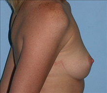 Breast Augmentation Before Photo by Daniel Mills, MD; Laguna Beach, CA - Case 24635