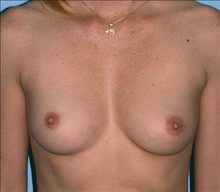 Breast Augmentation Before Photo by Daniel Mills, MD; Laguna Beach, CA - Case 24635
