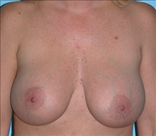 Breast Augmentation After Photo by Daniel Mills, MD; Laguna Beach, CA - Case 24640