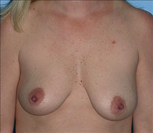 Breast Augmentation Before Photo by Daniel Mills, MD; Laguna Beach, CA - Case 24640